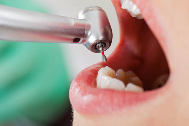 Best Emergency Treatment for Dental Infections or Abscesses in Queens, NY